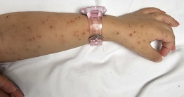 Contact tracing hadhaa nimijje, Meningococcal ge ithuru case eh neiy: HPA